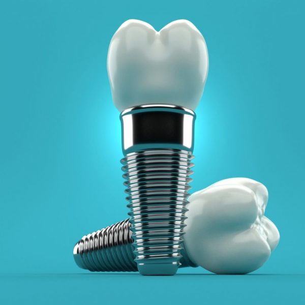 Εμφυτεύματα Δοντιών: Δόντια την Ίδια Μέρα με τη Μέθοδο All-on-4®