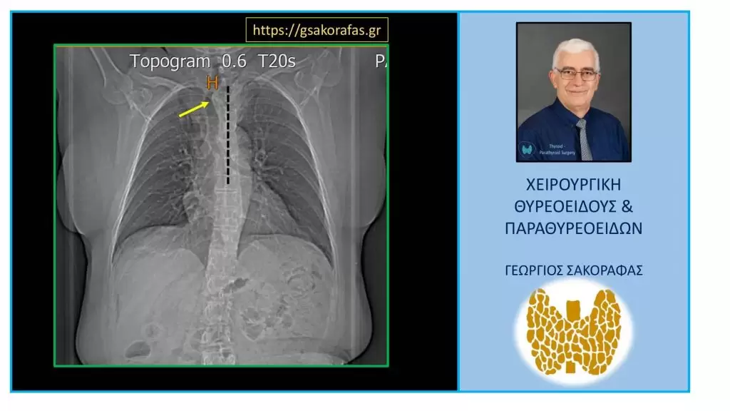 Βρογχοκήλη και πιεστικά φαινόμενα – Πραγματική Περίπτωση Ασθενούς 3 Βρογχοκήλη και πιεστικά φαινόμενα – Πραγματική Περίπτωση Ασθενούς