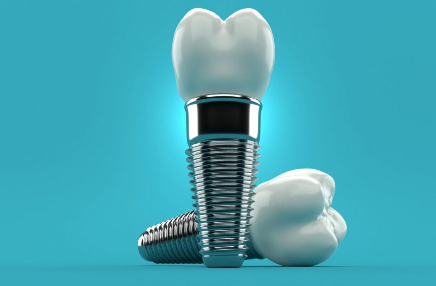Εμφυτεύματα Δοντιών: Δόντια την Ίδια Μέρα με τη Μέθοδο All-on-4®