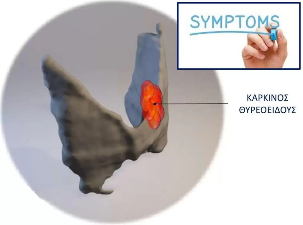 Καρκίνος θυρεοειδούς: 5 συμπτώματα που δεν πρέπει να αγνοηθούν.