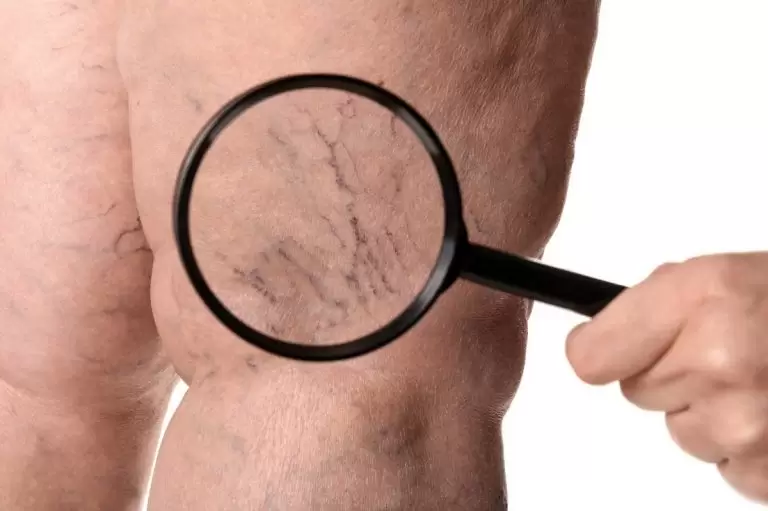 Φλεβική Θρόμβωση: Κορυφαίος Αγγειοχειρουργός Αναλύει τις 3 Βασικές Προϋποθέσεις Εμφάνισής της