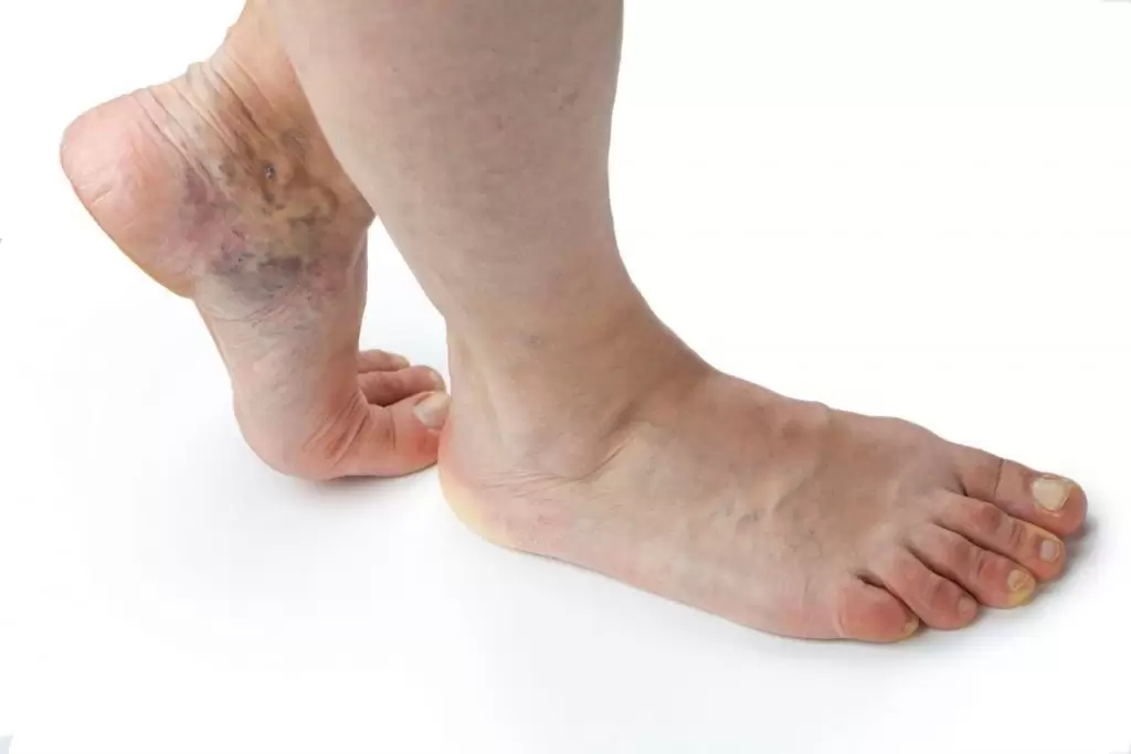 Τα 6 Πιο Σοβαρά Συμπτώματα της Φλεβικής Ανεπάρκειας